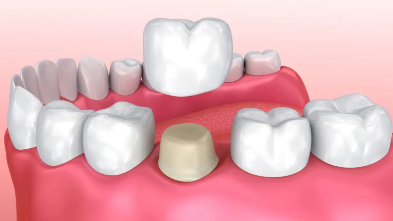 Dental Crown 