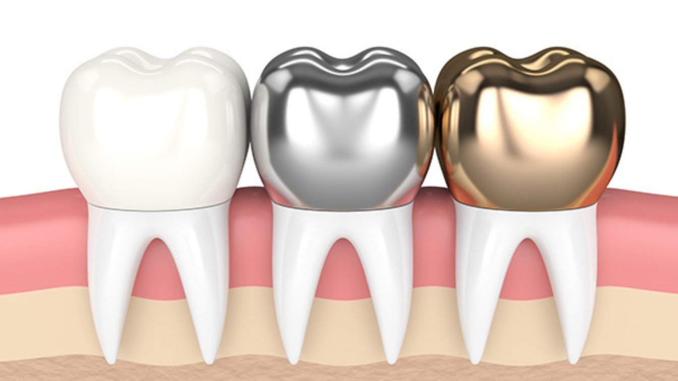 Dental Crown Types