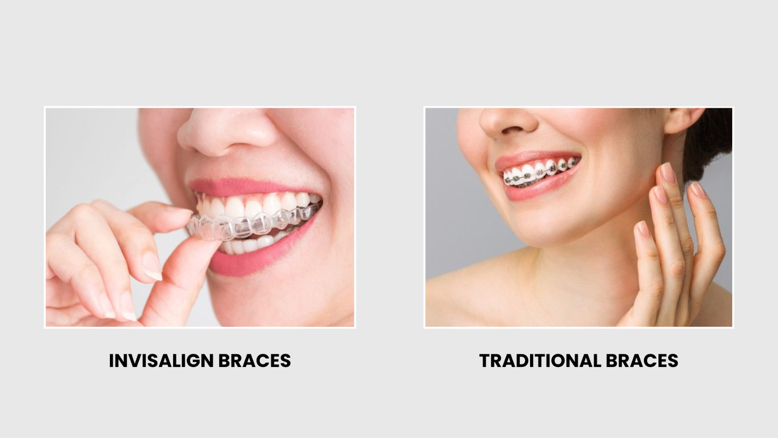 Invisalign Braces Vs Traditional Braces