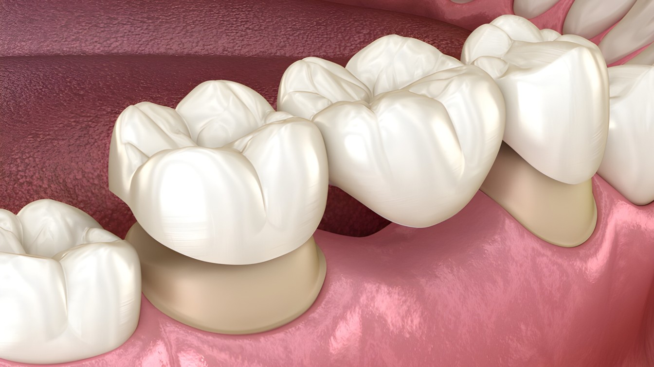 Dental Bridge