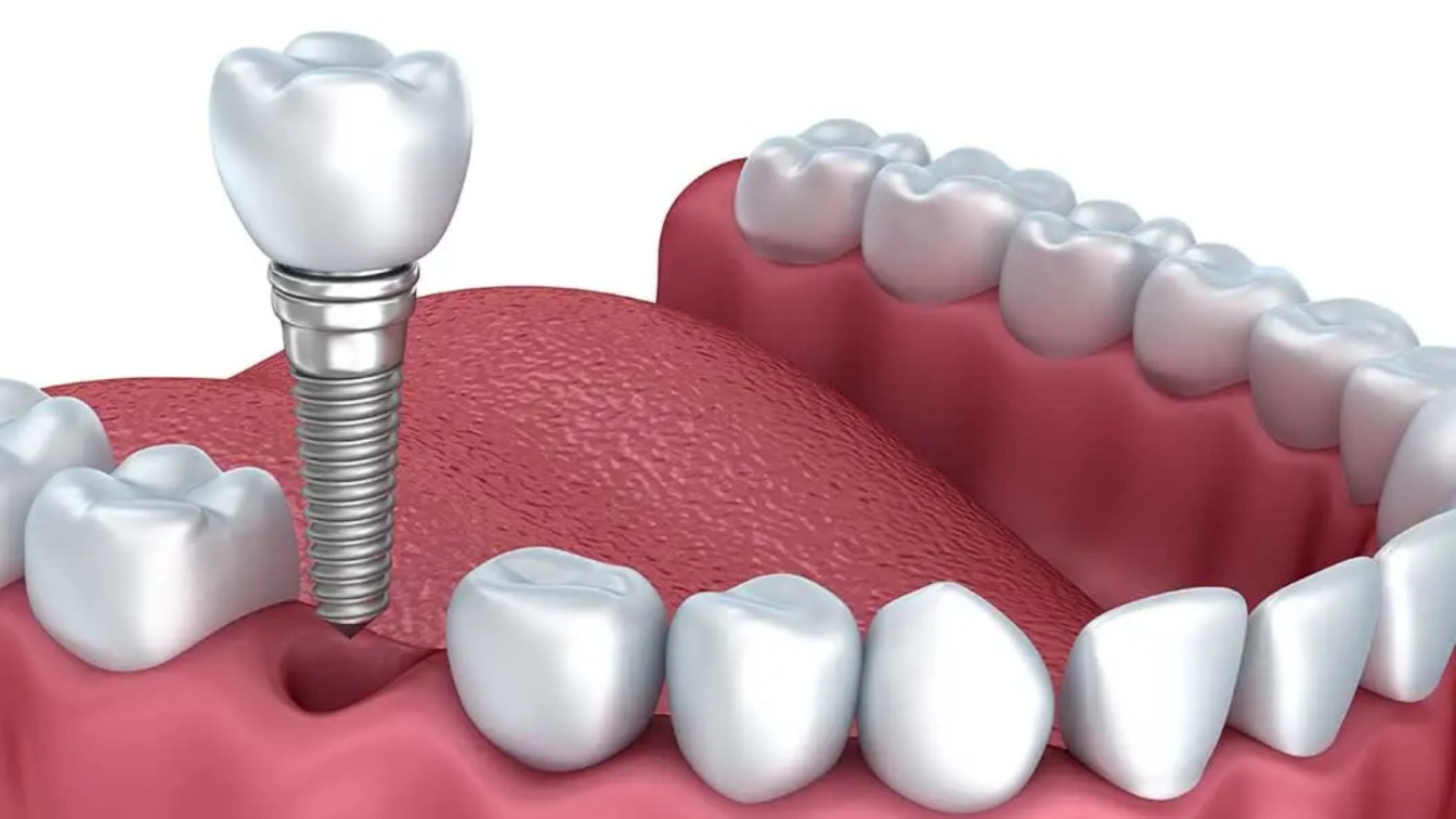 Dental Implants
