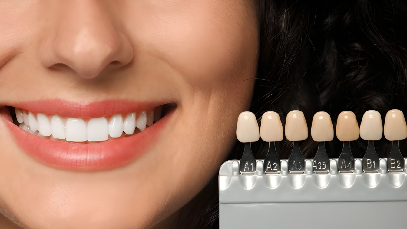 Dental Veneers
