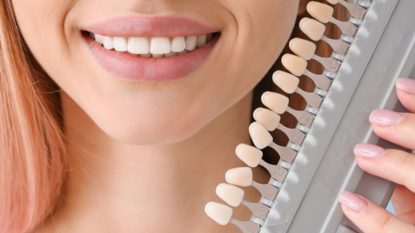Porcelain Veneers