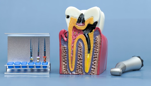 Common Concerns After Getting A Root Canal